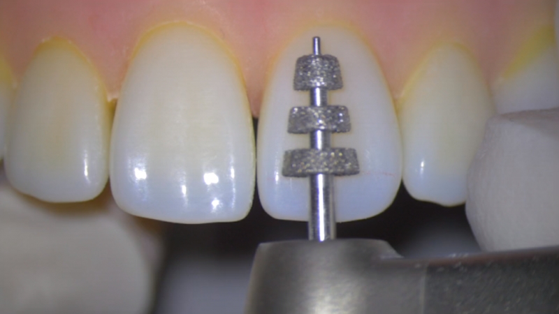 Anterior Crowns: Conventional Prep | Spear Education